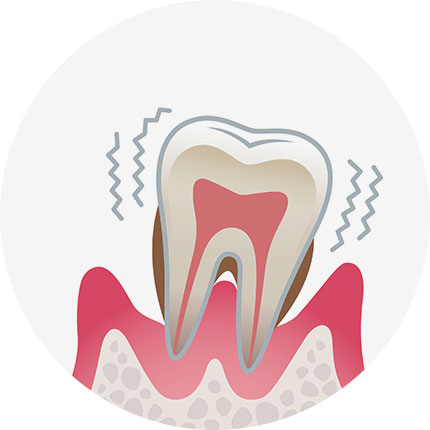 歯周炎（重度）