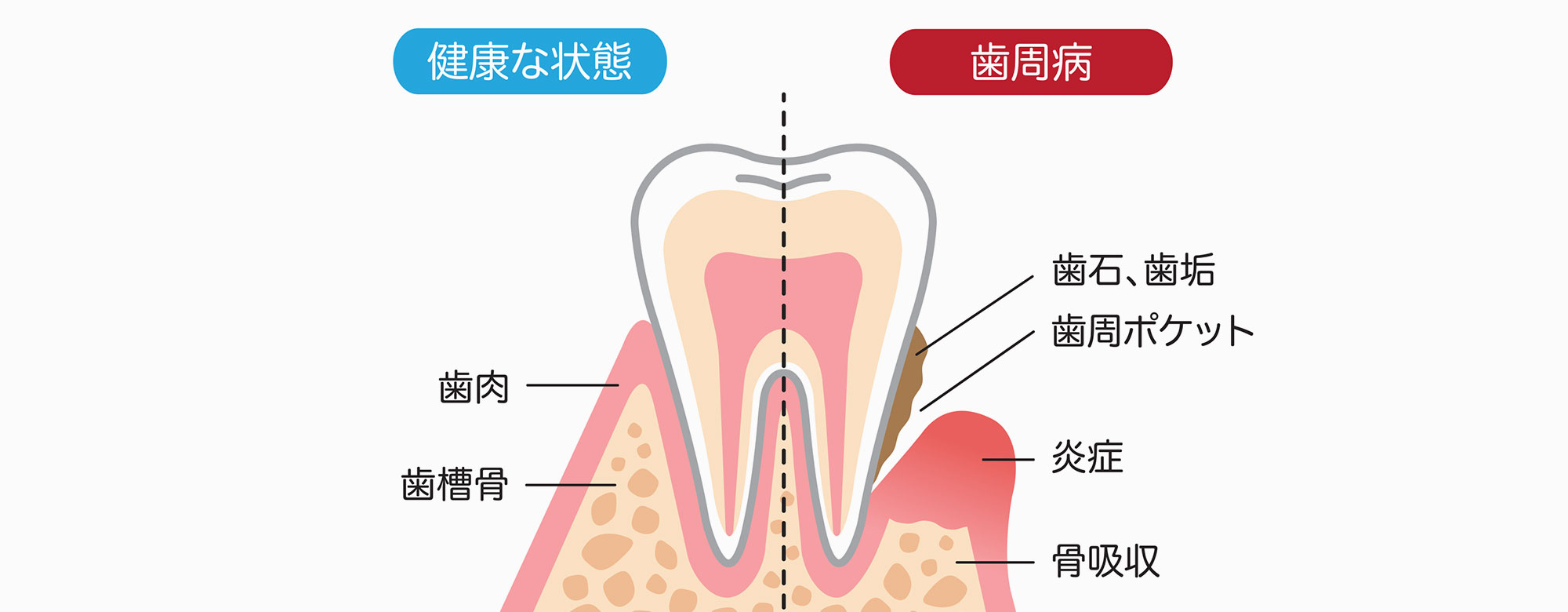 周病治療